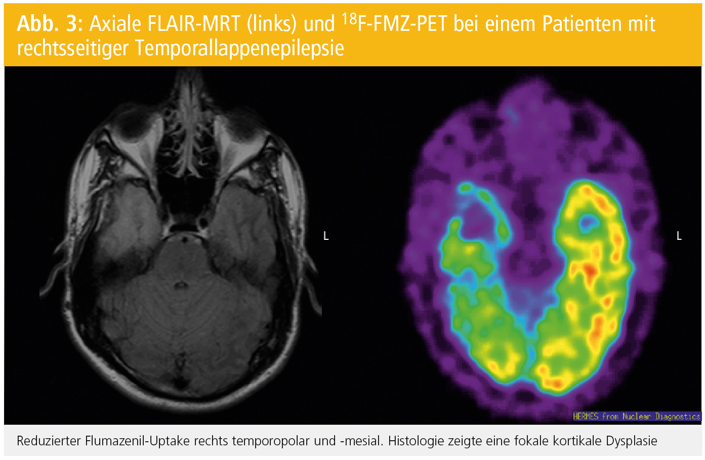 Wie Sieht Epilepsie Im Mrt Aus www.medmedia.at